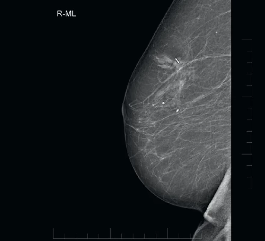 Tumor prsu – screeningový snímek + snímek se značením ložiska zrnem. / Breast tumor – screening image + image with lesion marked by seed.