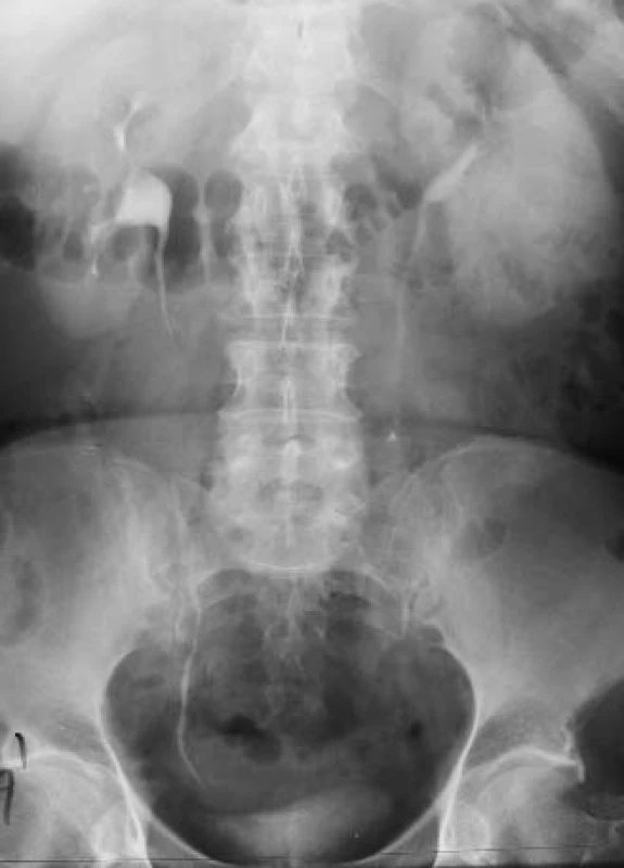 Tumor renis, vyklenutí kontury levé ledviny, nezřetelný dutý systém dolního a středního kalichu (IVU).