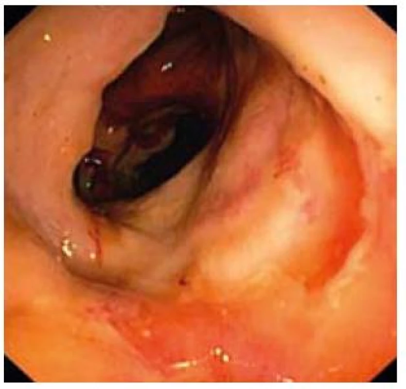 Závažný nález kontinuálnej ulcerácie celej sliznice.
Fig. 7. Serious finding of continuous ulcerations of the entire mucosa.