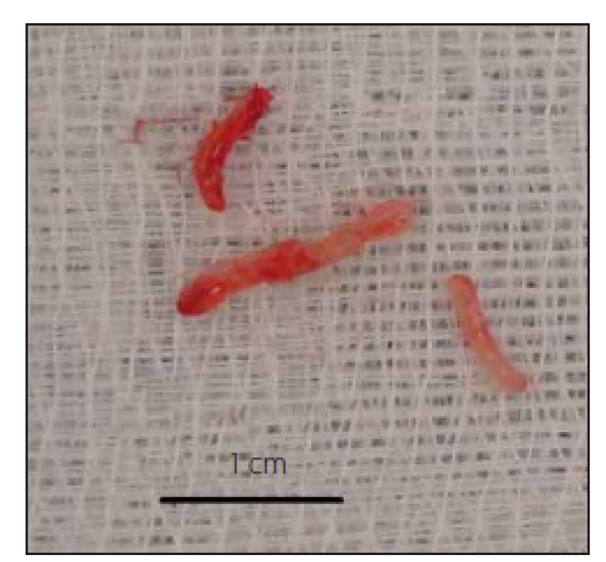 Odebrané bioptické vzorky.
Fig. 3. Bioptic samples.