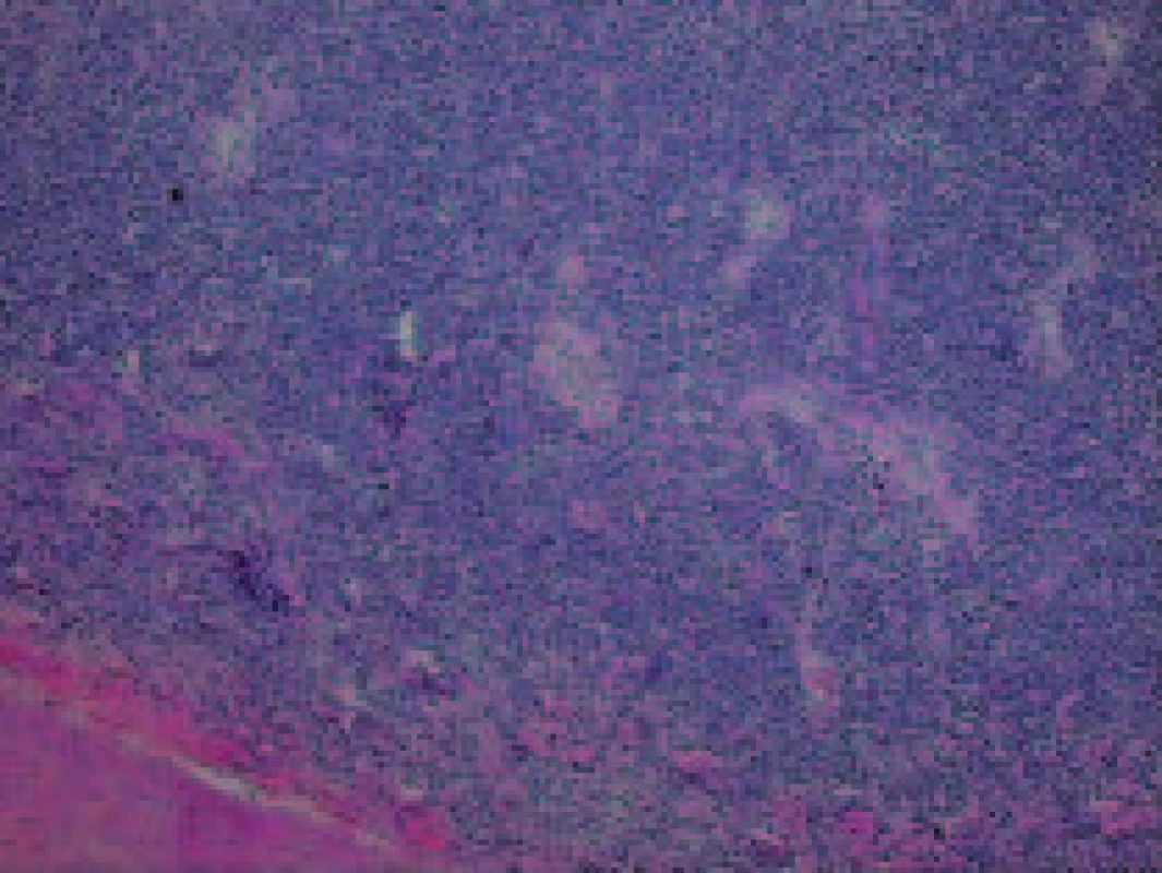 Mikroskopický obraz infiltrace maligním lymfomem pod arteria renalis štěpu ledviny.