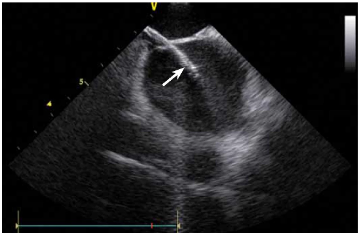 Řiditelný transseptální sheath (Agilis, St. Jude Medical) zavedený z pravé síně do levé síně punkcí mezisíňového septa.