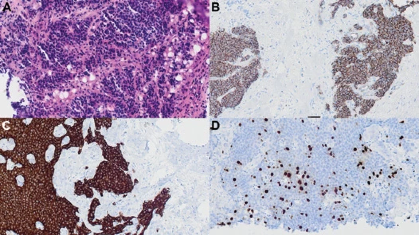 The neuroendocrine tumor grade 2 in the liver biopsy.