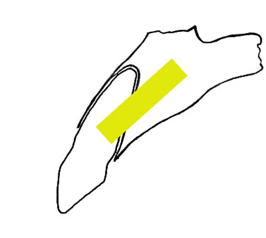 Umístění implantátu (žlutě) při tzv. okamžité rekonstrukci. Tilted implantát směřuje do palatinální lamina dura.