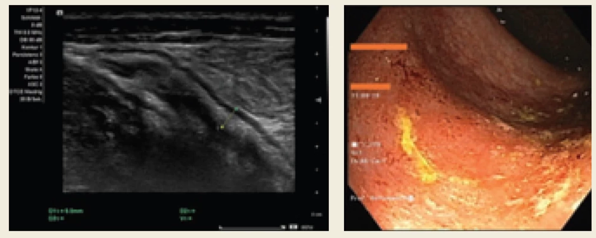 Ultrasonografi cké a endoskopické vyšetření potvrzovaly vysokou aktivitu UC po selhání terapie ustekinumabem v srpnu 2023.