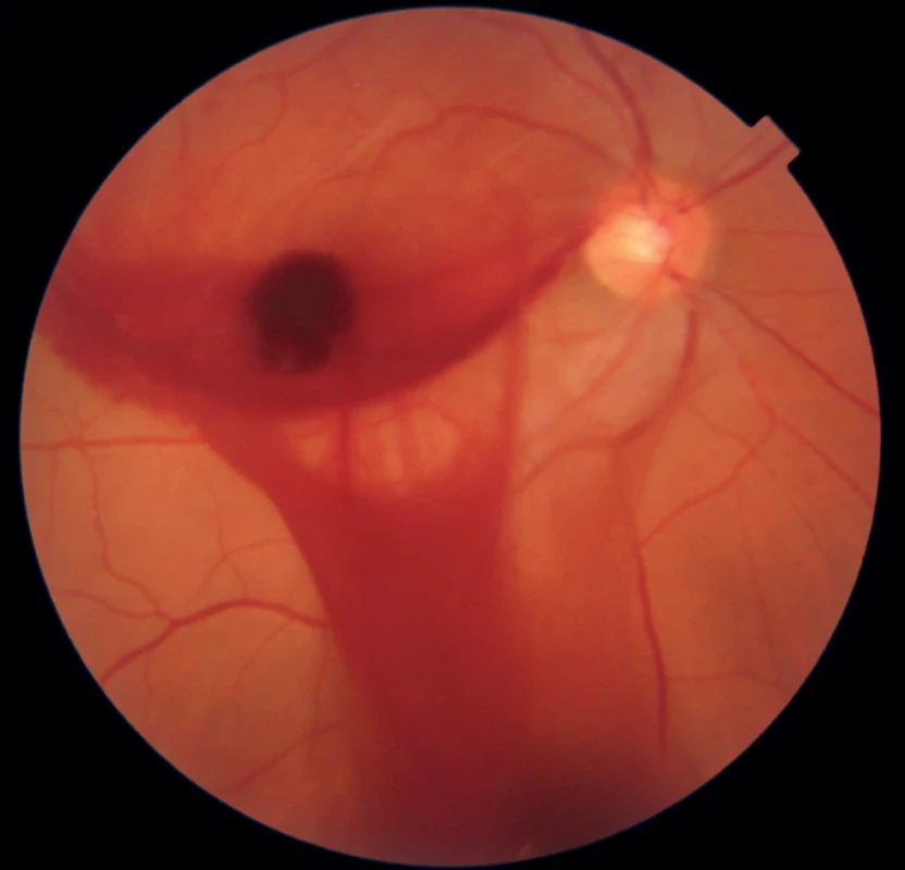Photo of macular area after Nd-YAG hyaloidotomy