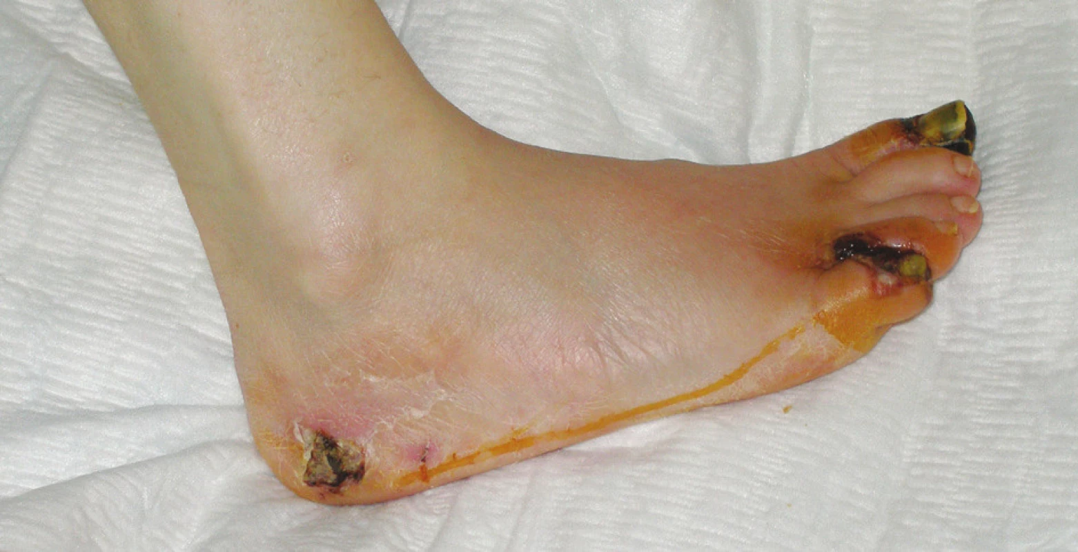 Neuroischemická diabetická noha – suchá gangréna distálneho článku palca, malíčka a medziprstového priestoru medzi 4. a 5. prstom pravej nohy, nekróza v laterálnej oblasti kalkanea (Meggit-Wagner 4. stupeň)
Fig. 1. Neuroischemic diabetic foot – dry gangrene of the distal phalanx of the big toe, the little toe and the 4<sup>th</sup> interphalangeal space, necrosis in the lateral calcaneal region (Meggit-Wagner grade 4)