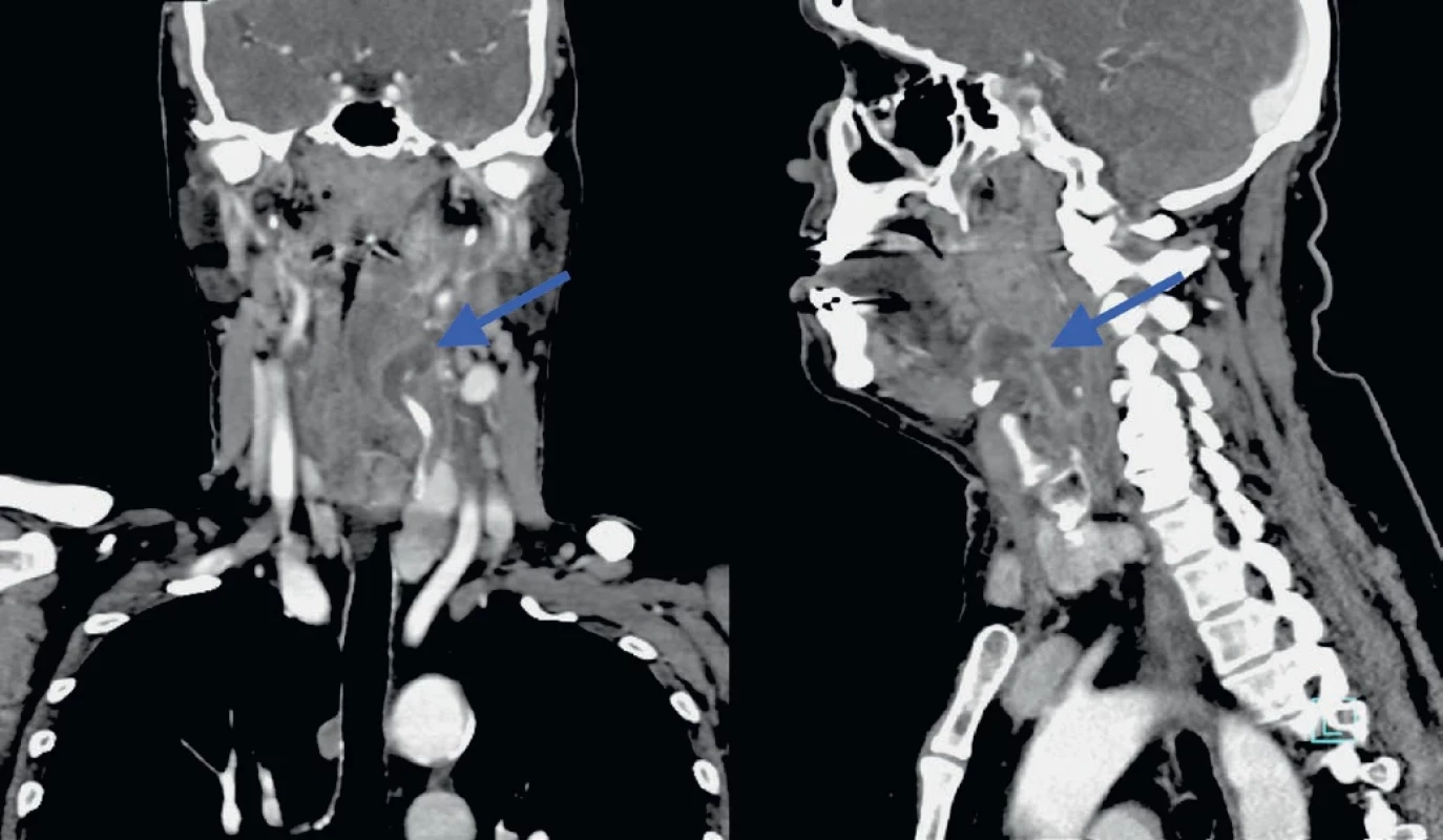 Parafaryngeální absces vlevo, CT s kontrastní látkou, sagitální a koronární řezy, absces označen šipkou.