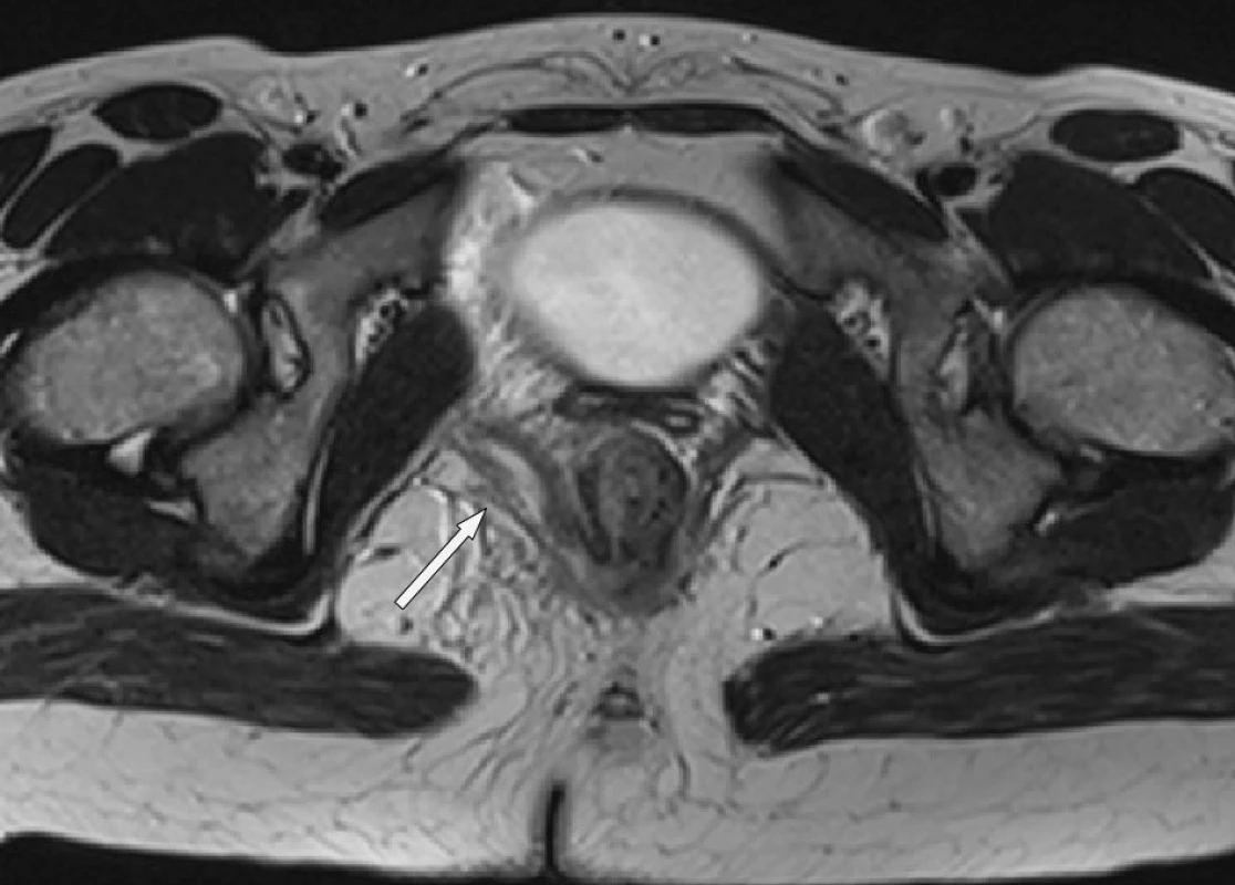 Štěrbinovitý absces v musculus levator ani vpravo
Fig. 4. Fissure abscess in the right musculus levator ani