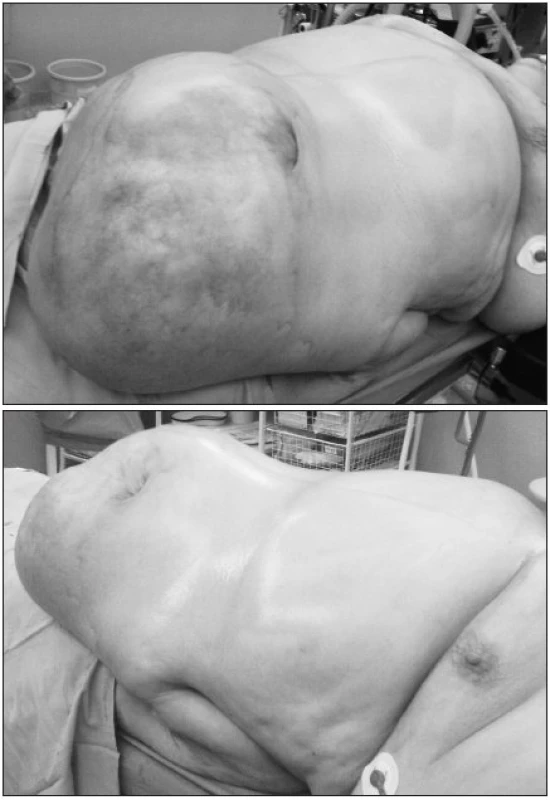 ,2: Inkarcerovaná ventrálna hernia – predoperačný nález
Fig. 1., 2. Incarcerated ventral hernia – preoperative finding
