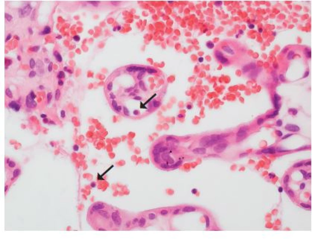 <b>Fetomaternální hemoragie</b>. Placenta z 35. týdne gravidity, porod akutním císařským řezem pro hrozící hypoxii plodu. Porozen mrtvý plod, při pitvě pouze absence macerace a anemický vzhled orgánů. Matka 32 let, po porodu zvýšená hladina fetálního hemoglobinu v krvi. Jaderné fetální erytrocyty (šipky) i mimo fetální krevní řečiště (HE, zvětš. 400x).