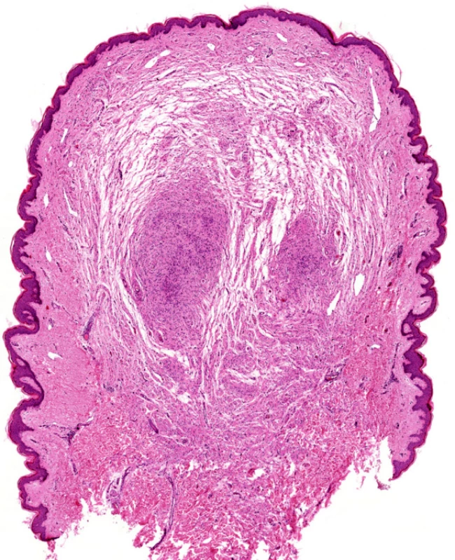Neurofibrom, hematoxylin-eozin, původní zvětšení 20x.