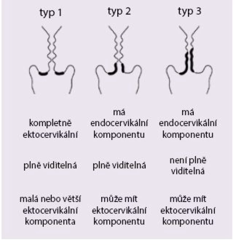 Typy transformační zóny
