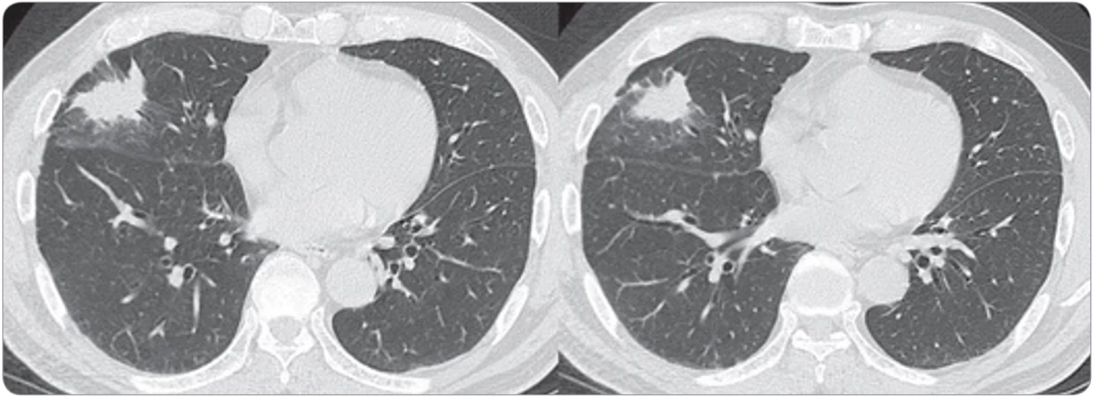 A chest CT on admission revealed a 35 × 24 mm mass in the middle lobe of the right lung.