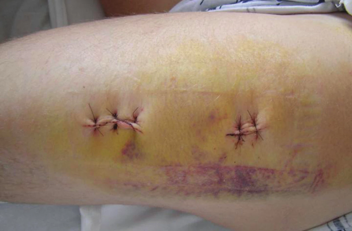 Kožní incize po sutuře rány
Fig. 7. Skin incision following wound suturing