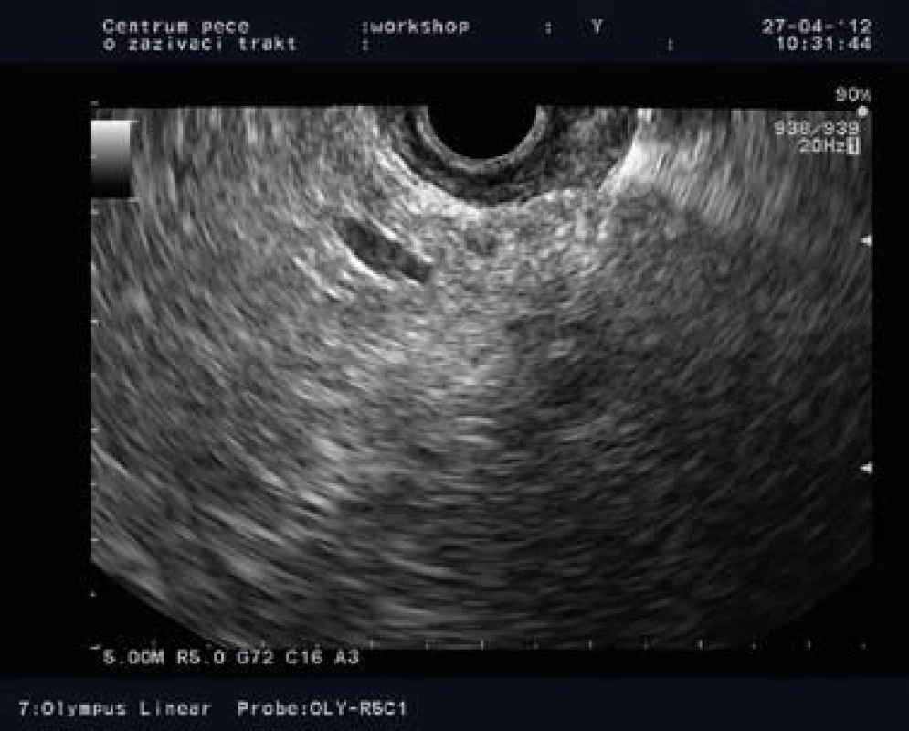 Lineárna endosonografia: reziduum cysty priemeru 10 mm v hlave pankreasu so zavedenou aspiračnou ihlou 3 mesiace po prvej alkoholovej ablácii.
Fig. 4. Linear-array endosonography: a 10 mm cyst residuum in the pancreatic head with FNA needle within 3 months after the first ethanol ablation.