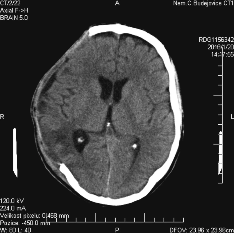 Na kontrolní CT vyšetření po 20 dnech se mozková tkáň nevyklenuje nad úroveň kostního defektu a mozkové kontuze jsou již vstřebány
Fig. 5. Control CT examination on Day 20: no cerebral tissue herniation through the bone defect is detected and brain contusions are resorbed