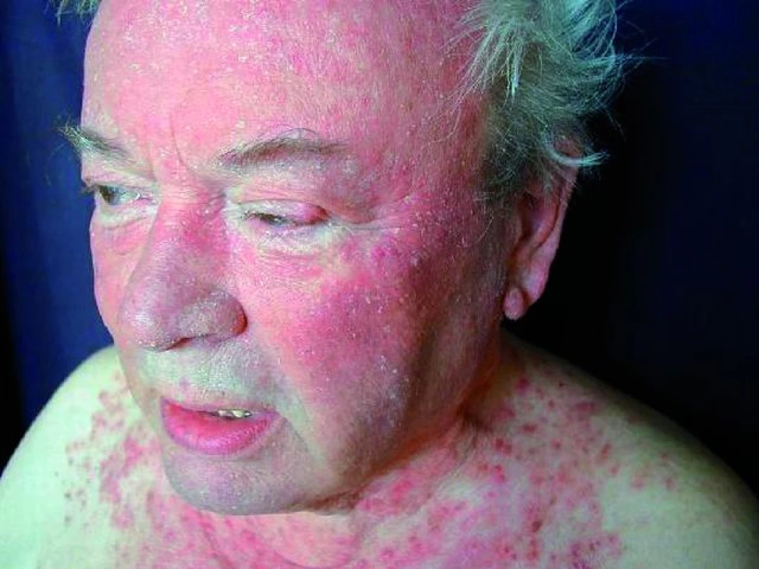 Rosacea granulomatosa s postižením obličeje a krku (Foto H. Duchková)