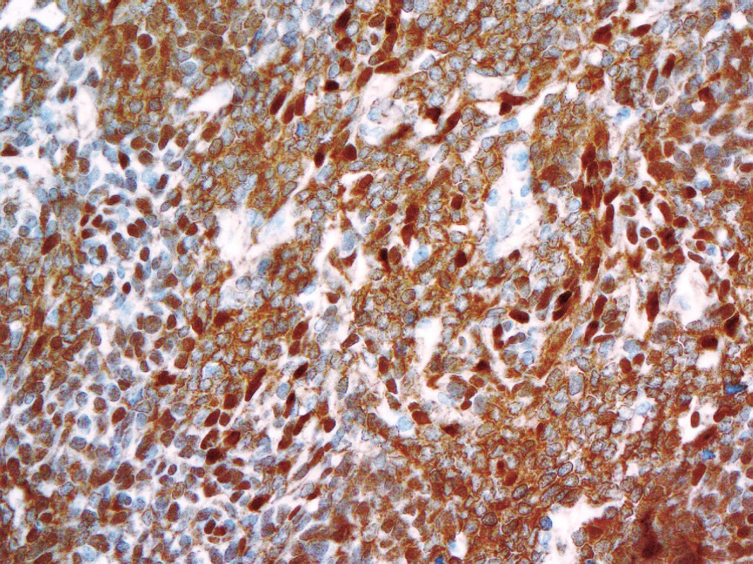 Kolísající jaderná imunoexprese beta-cateninu u WNT- aktivovaného meduloblastomus prokázanou mutací v exonu 3 genu <i>CTNNB1</i> (400x).