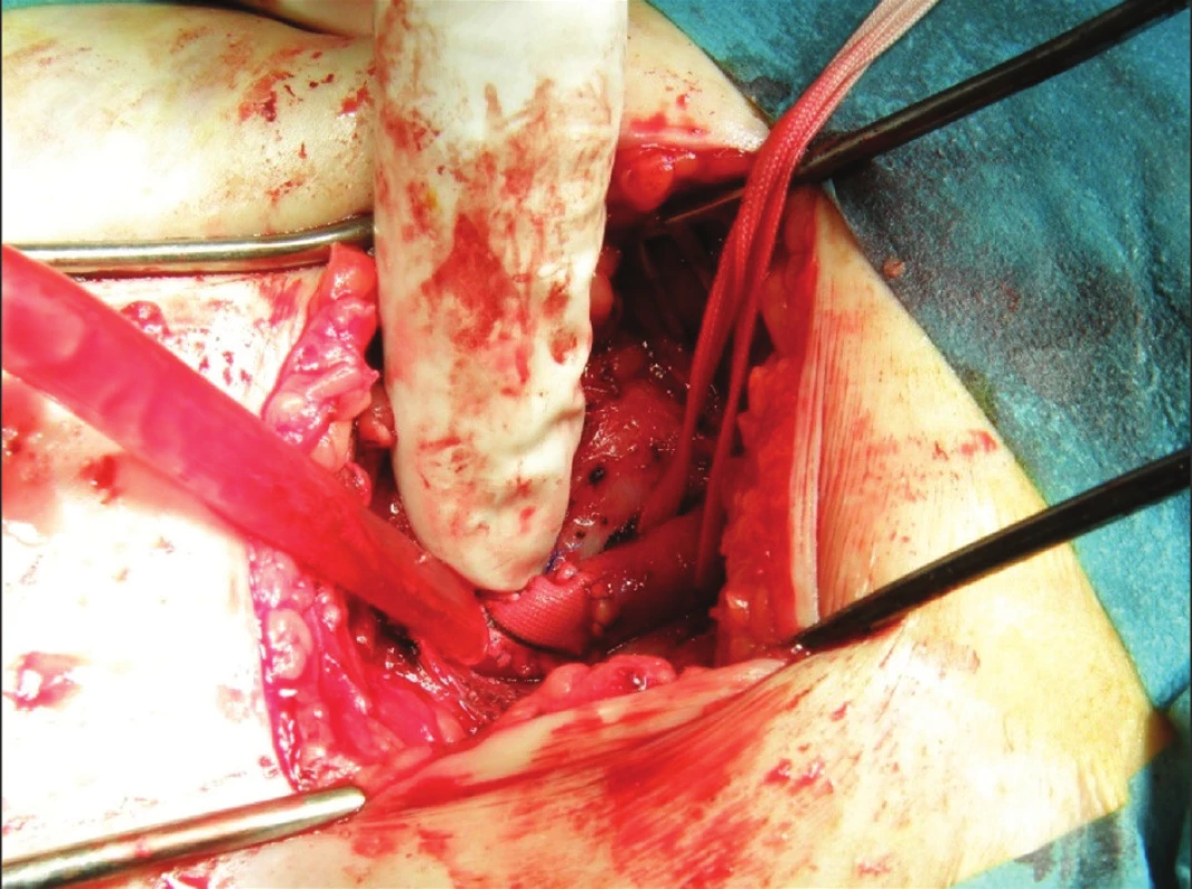 Plastika stehenní tepny
Fig. 3. Femoral artery surgery