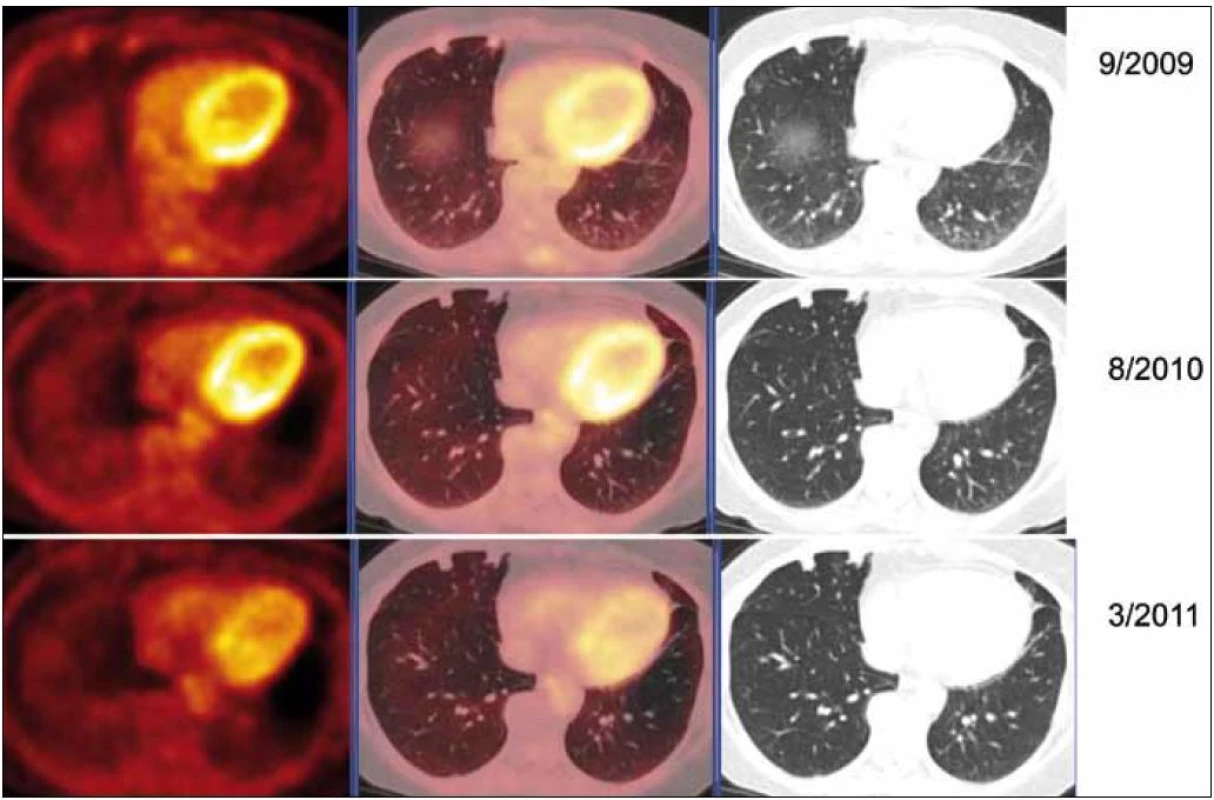 PET-CT zobrazení jednotlivých plicních ložisek v čase (září roku 2009, srpen roku 2010, březen roku 2011), axiální řezy, ve sloupcích zleva PET, PET/CT a CT. PET obraz je v barevné škále „Hot Body“, řazeno odshora. Dvě denzní subpleurálně uložené léze ventrálně v S5 vpravo bazálně. V čase je vidět pokles metabolické aktivity (PET řezy, iniciálně SUV<sub>max</sub> 1,82 – laterálnější a 1,8 mediálnější), zatímco velikost ložisek je přibližně stacionární (CT řezy, 11 × 9 laterálně a 8 × 9 mm mediálně).