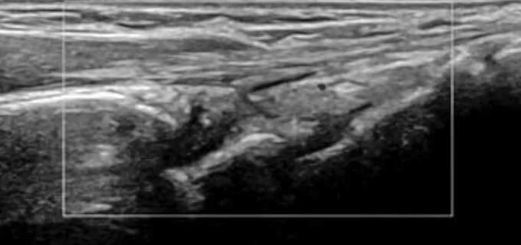 Dorzální podélný řez nad karpem s drobným výpotkem, bez hypervaskularizace. Nález: nanejvýš mírná artritida, diferenciálnědiagnosticky normální nález.