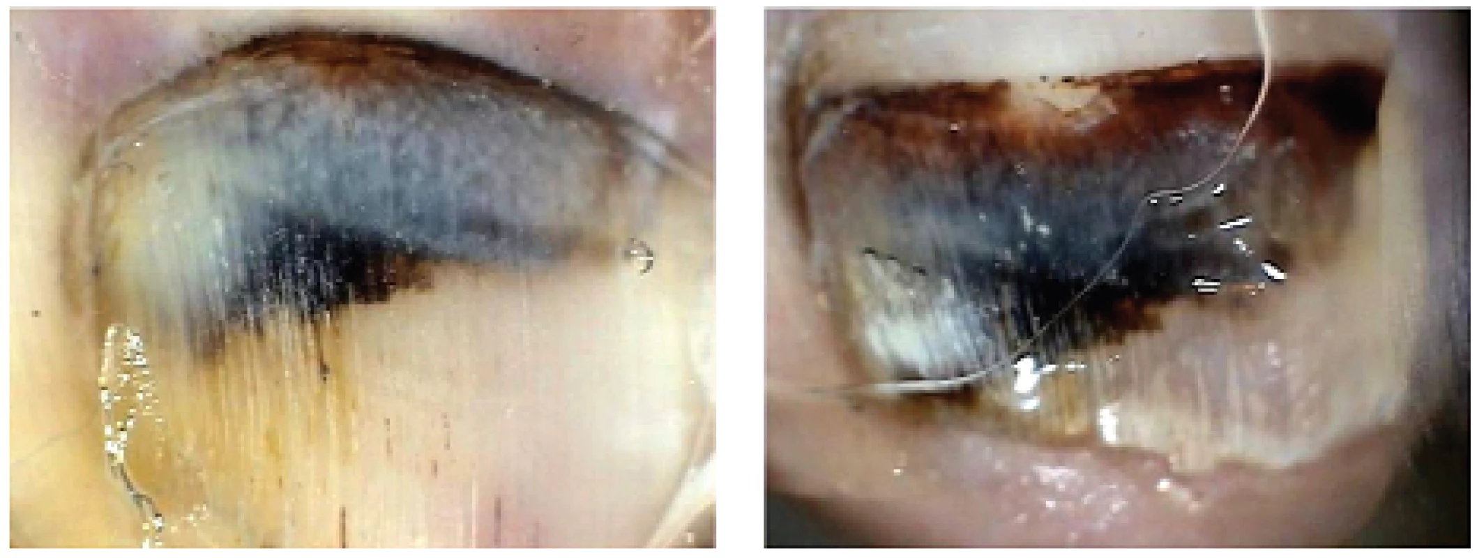 Odrůstání subunguálního hematomu – vyšetření digitálním dermatoskopem