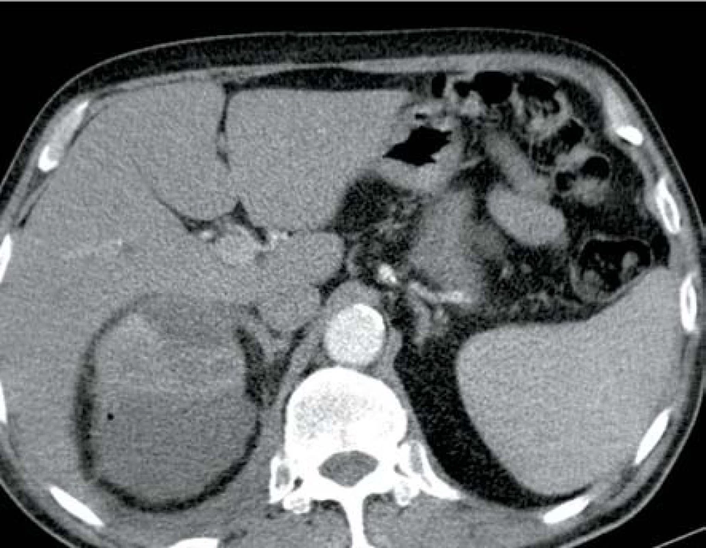 Ledvinný absces pravé ledviny s drobným ložiskem plynu
Fig. 4. Abscess in right kidney with slight gas deposittického