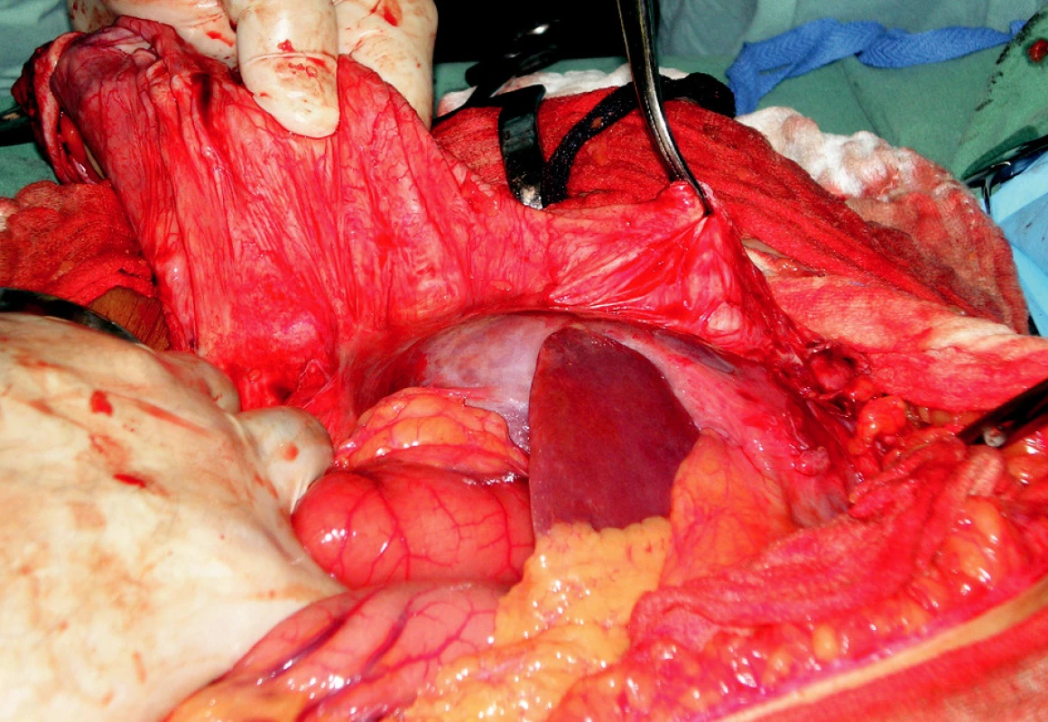 Peroperačne vidno obrovský vak hernie, kde nie je možná separaćia ani inlay plastika
Fig. 5. Intraoperative view of the large hernial sac, where neither separation, nor inlay repairs are possible
