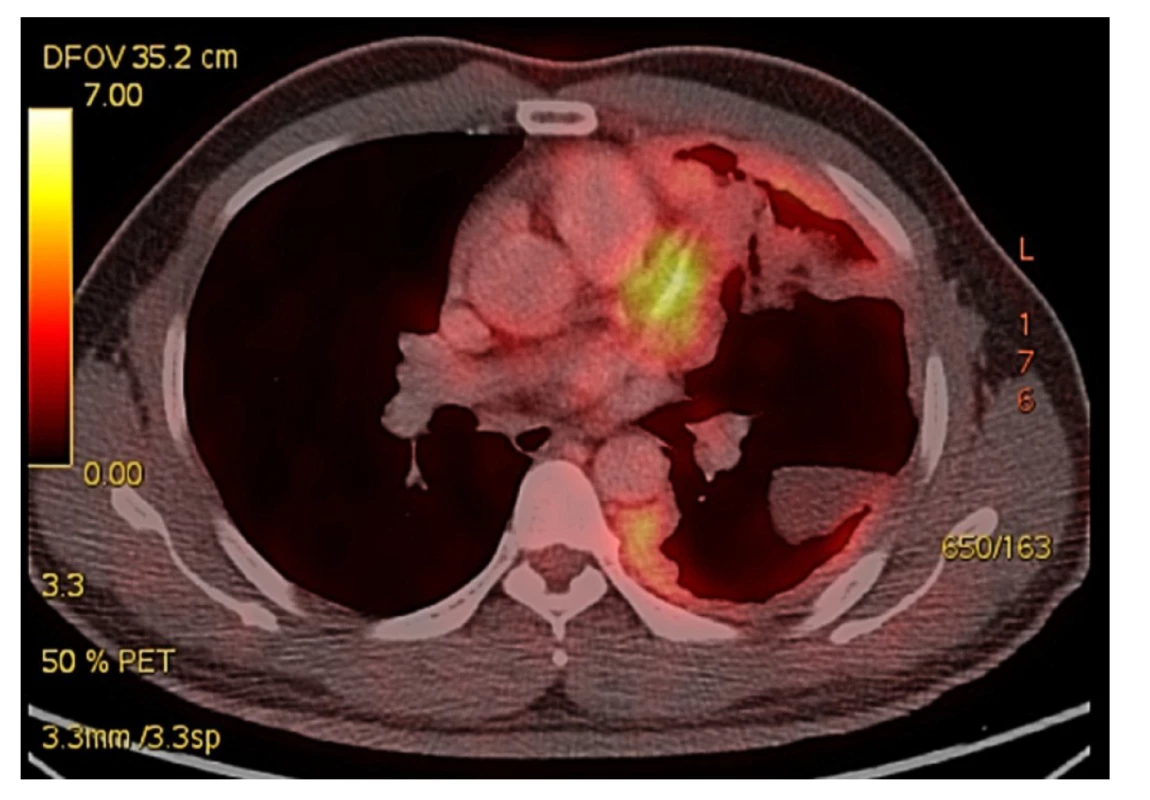 Předoperační PET CT s postižením levého hemithoraxu
maligním mezoteliomem, nádorová tkáň prorůstá
do plicního parenchymu a ventrálně do mediastina
s intimním vztahem k perikardu<br>
Fig. 1: Preoperative PET CT with involvement of the left
hemithorax with malignant mesothelioma. Tumor tissue
grows into the lung parenchyma and into the anterior
mediastinum adjacent to the pericardium