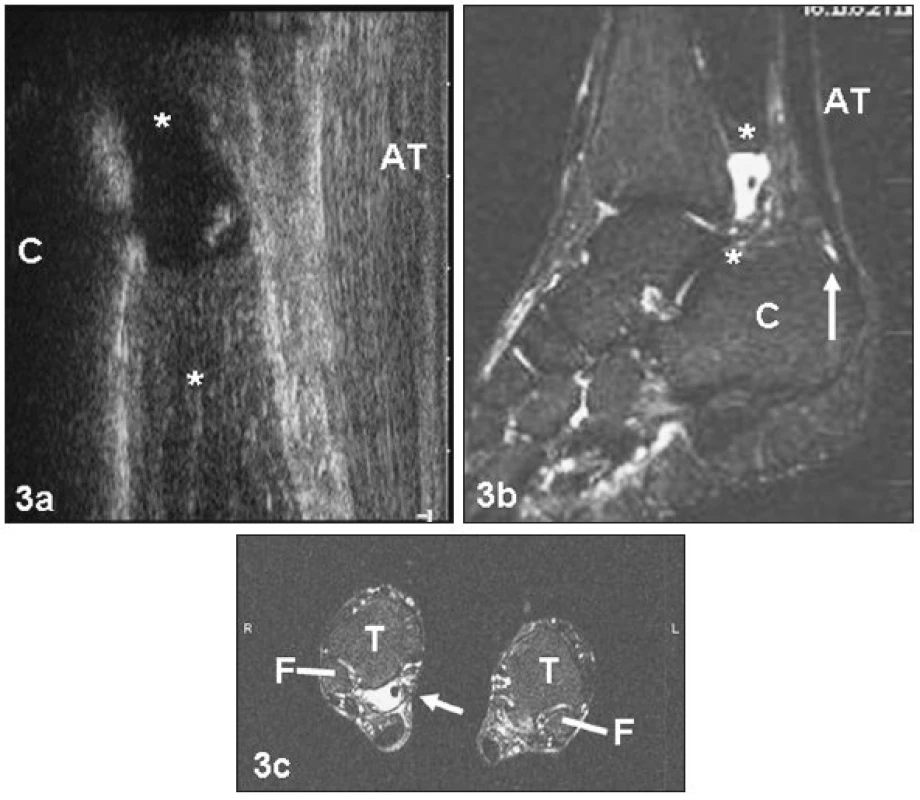 a. Kazuistika e). Ultrasonografie pravé paty zobrazující preachilární prostor s patrnou kolekcí tekutiny (**)
b. MR stejné oblasti, prostor vyplněný tekutinou označen (**), šipka označuje zvýšený signál v oblasti minimálně naplněné RB
c. MR stejné oblasti jako na předchozích obrázcích, šipka označuje rozšířenou synoviální pochvu kolem šlachy m. tibialis posterior dx. F – fibula, T – tibie
Fig. 3a. Ultrasonography of the right pre-achillar region of a 56-year-old patient (case report e – cross country runner). ** – space containing pathological fluid and a free foreign body (x)
b. MR image of the same region (the same patient as in Fig. 3a). The arrow designates the region of normally shaped signal in the region of minimally filled RB. Asterisk – the cavity containing pathological fluid and a free foreign body
c. MR image (transversal projection) of the same region as in the two previous figures. The arrow designates an enlarged synovial sheath of the right tibialis posterior muscle. F – fibula, T – tibia