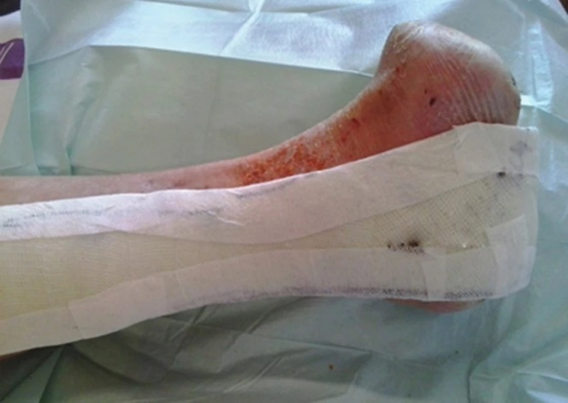 U-RCS dlaha
Fig. 5: Removable contact U-splint(U-RCS)