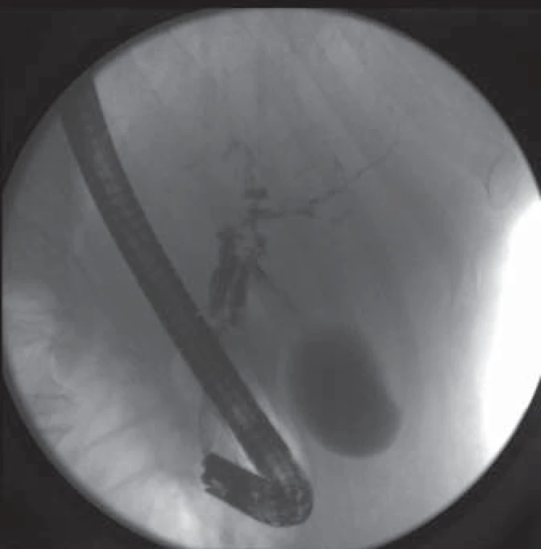 ERCP – stenóza střední a distální části ductus choledochus s prestenotickou dilatací, stenóza v odstupu pravého ductus hepaticus, četné stenózy intrahepatických žlučovodů.
Fig. 1. ERCP – stenosis of the middle and distal part of the common bile duct with pre-stenotic dilatation, stenosis of the right hepatic duct, numerous intrahepatic stenoses.