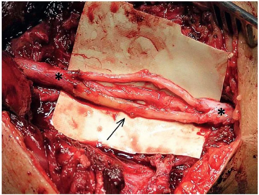Rekonstrukce n. radialis (proximální a distální pahýl označen hvězdičkou) v oblasti paže pomocí 3 nervových štěpů z n. suralis (šipka) délky 3,5 cm.