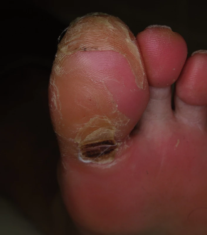 Syndrom ruka-noha při léčbě sorafenibem.