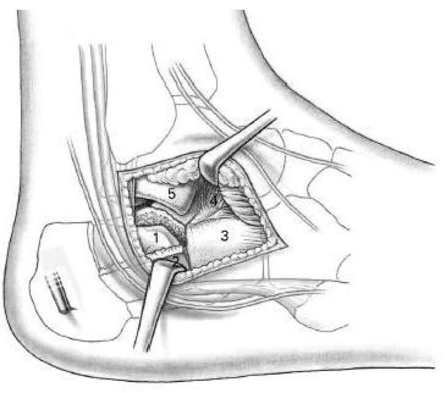 Laterální subtalární přístup dle Webera
1–posterolaterální kloubní fragment, 2–fragment laterální stěny, 3–processus anterior patní kosti, 4–ligamentum interosseum, 5–processus lateralis tali