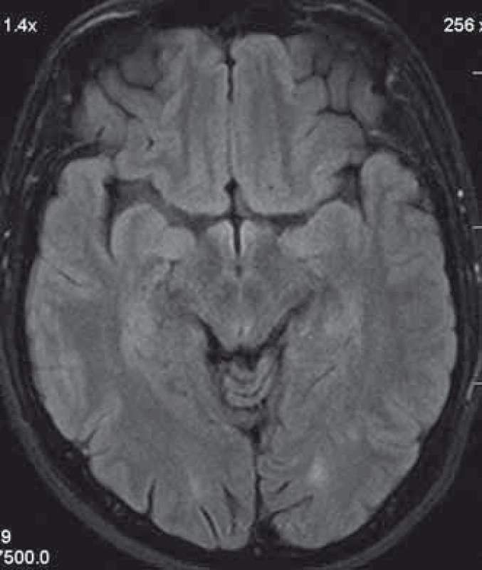 Patient´s head MRI.
A T2 hyperintensive demyelinating lesion in the left occcipitally lobe.