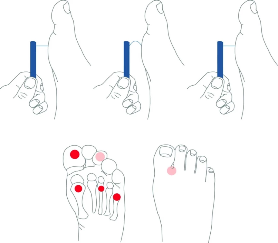 Vyšetření monofilamenty (zdroj: Boulton et al., 2008)