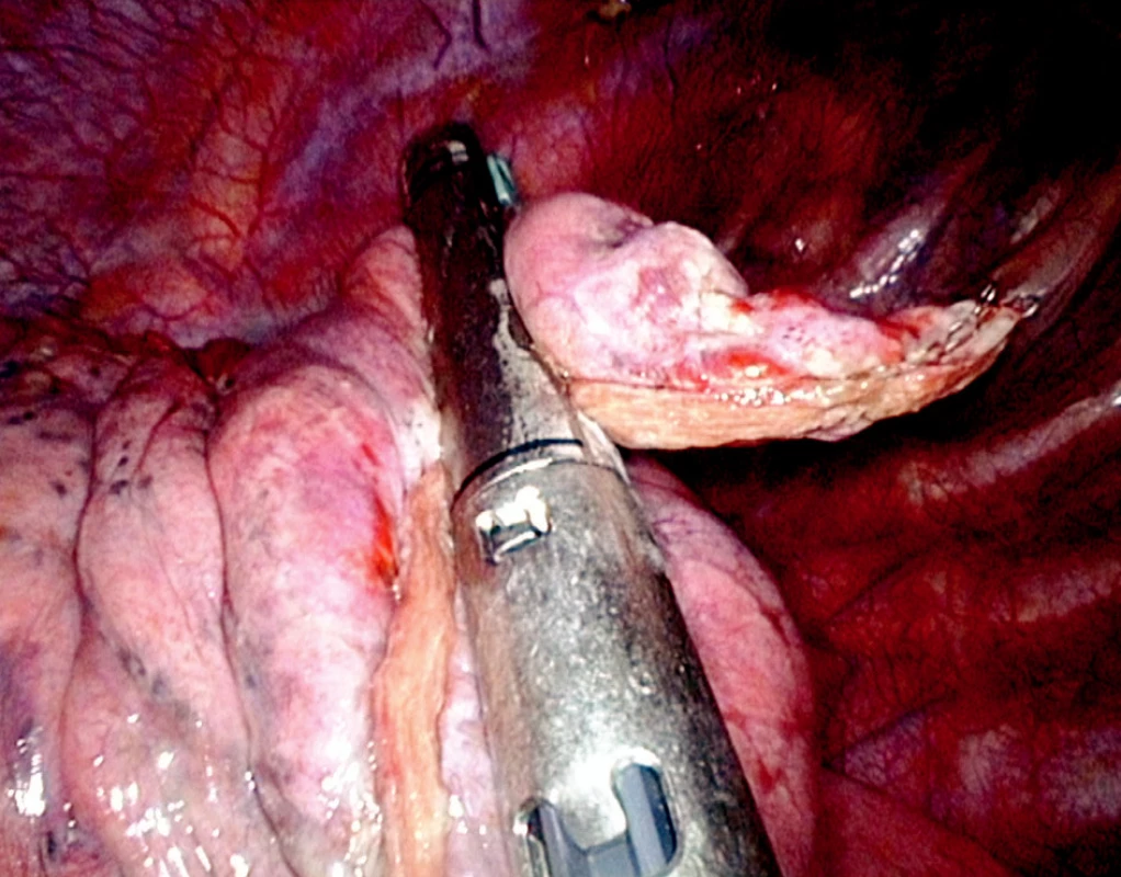 Endostaplerová resekce apexu pravé plíce (operační foto)
Fig. 3. Endostapler resection of the right pulmonary apex (intraoperative photo) 
