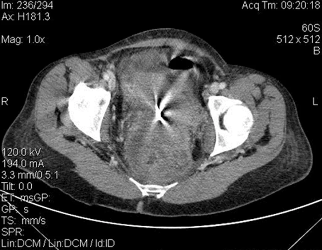 CT obraz tumorózní masy malé pánve
Fig. 3: CT image of pelvic tumour mass