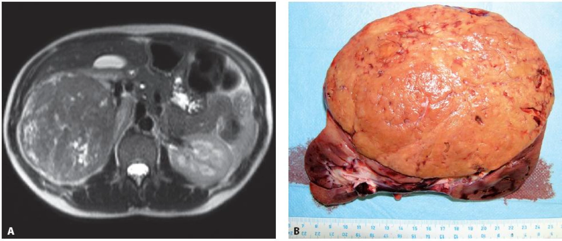 Případ 24leté ženy ve 4. měsíci gravidity, dle MRI. A – objemný tumorem pravé ledviny T3aN0M0 (11), provedena transperitoneální nefrektomie vpravo, B – disekovaný operační preparát), následný spontánní porod v řádném termínu. Šest let od operace bez recidivy tumoru.
Fig. 4. Twenty four year old woman, 4 months pregnant. A – a large tumour of the right kidney T3aN0M0 (11) seen on MRI. Transperitoneal nephrectomy performed, B – surgical specimen). Patient delivered a healthy baby. Patient is without recurrence of disease on the 6 years follow-up examination.