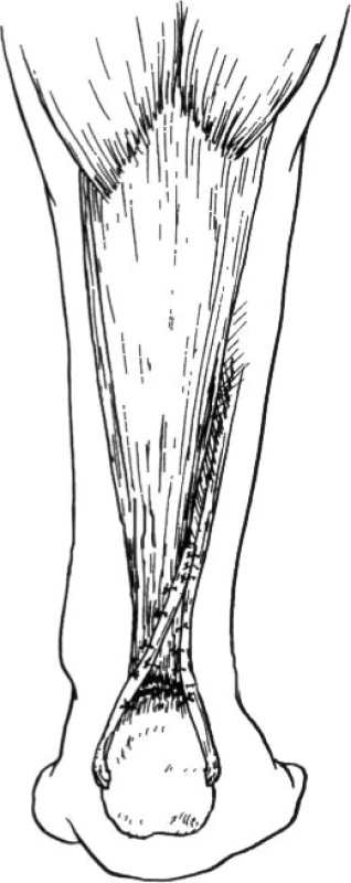 Plastika dle Teuffera [13]
(Volně podle Teuffer, A.P. Traumatic rupture of Achilles tendon: reconstruction by transplant and graft using the lateral peroneus brevis. The Orthopedic clinics of North America. 5, 89–93, 1974.)