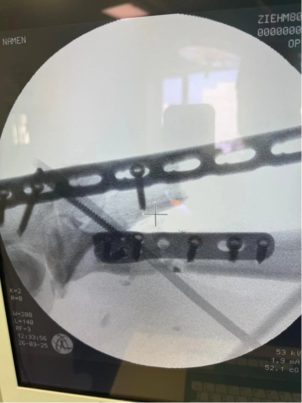  Peroperační rtg – ulna i radius stabilizovány zamykatelnými dlahami