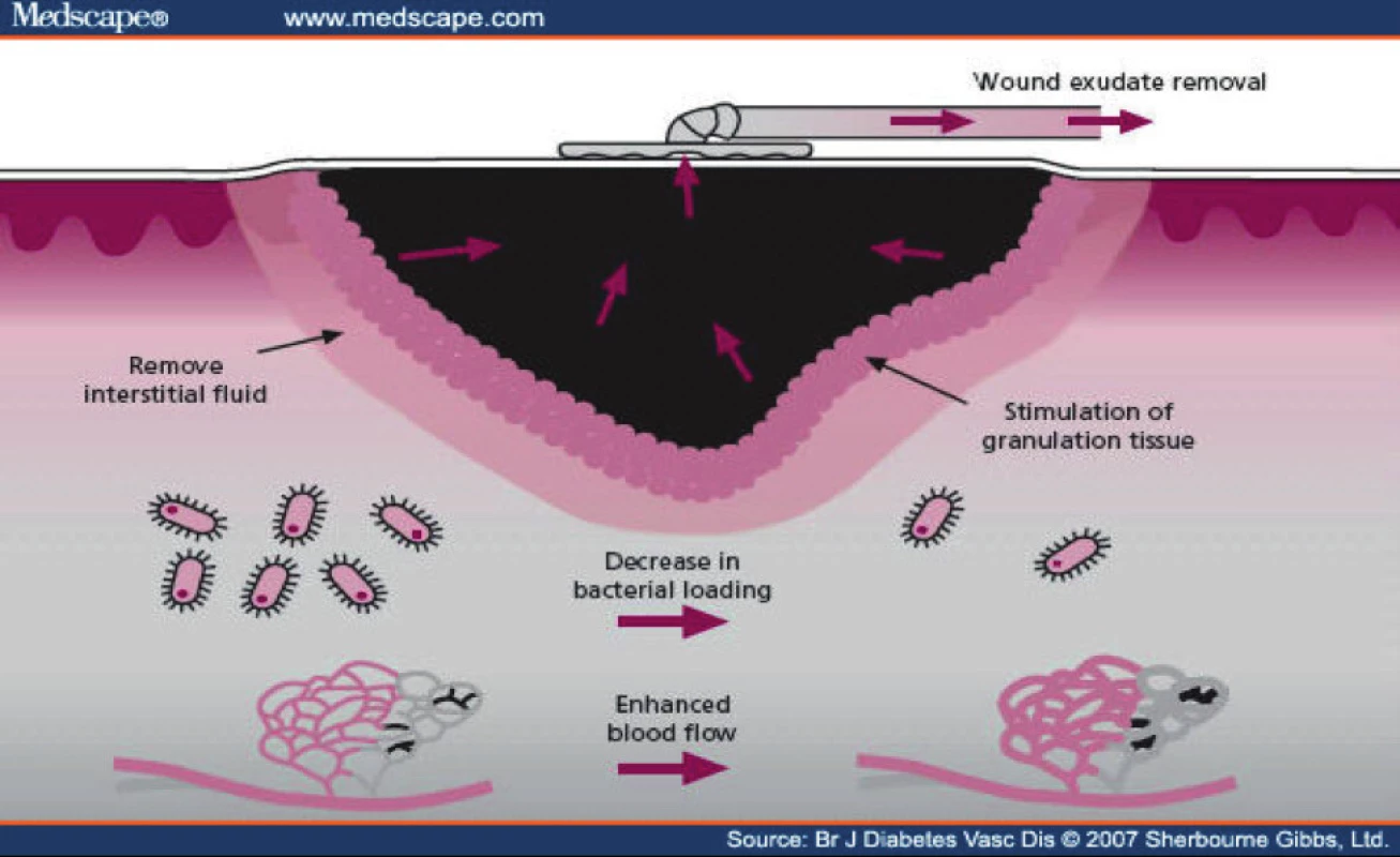 Mechanismus působení V.A.C (Vacuum assisted closure)