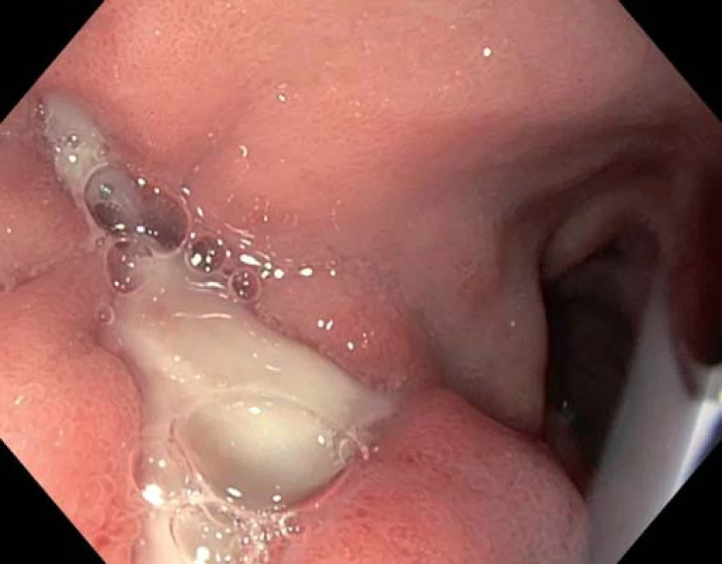 Cholecystoduodenální fistule.
Fig. 4. Cholecystoduodenal fistula.