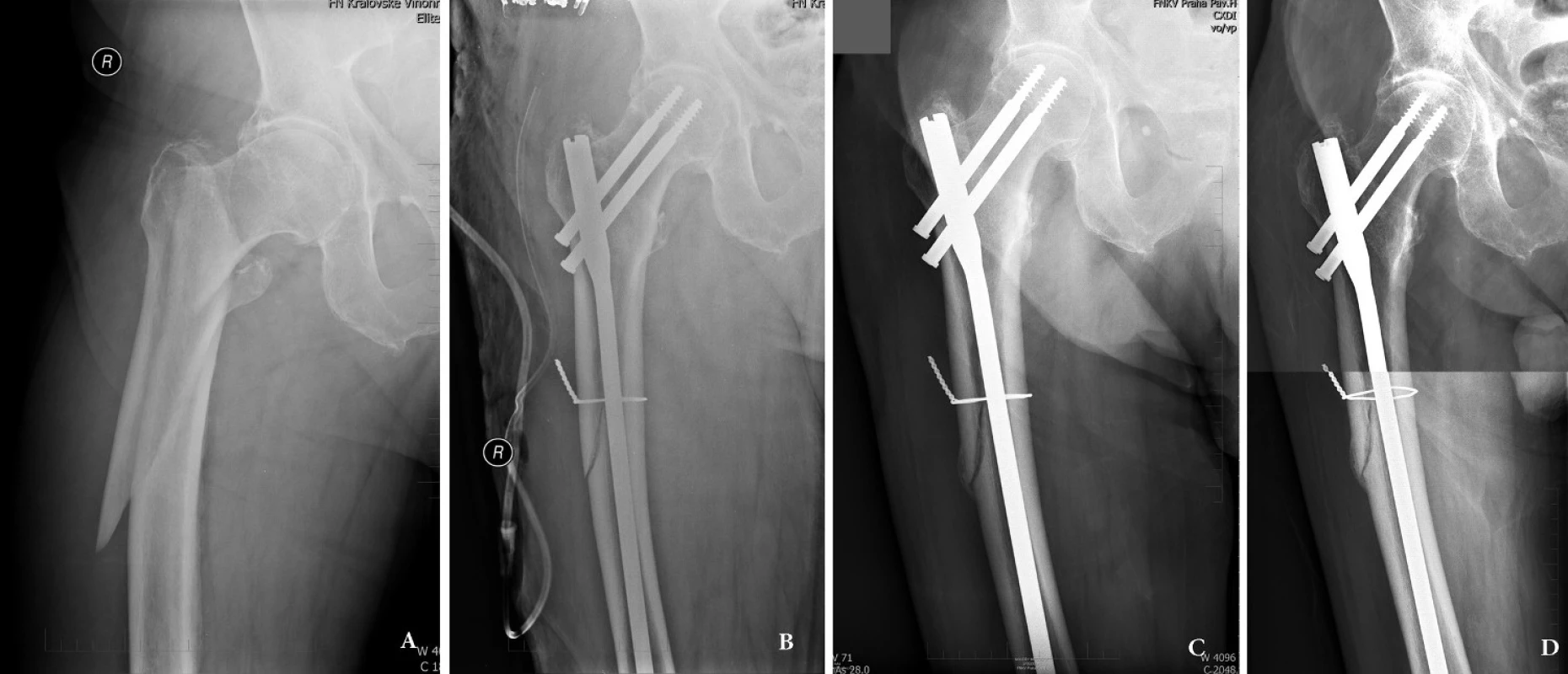 Subtrochanterická zlomenina u 80letého muže: a – úrazový snímek, patrná varozita proximálního fragmentu; b – osteosyntéza dlouhým rekonstrukčním hřebem Medin, před zavedením hřebu fragment velkého trochanteru a laterální kortikalis zajištěn cerkláží; c – ve 3 měsících se zlomenina hojí svalkem, d – stav 10 měsíců po úrazu, zlomenina je zhojená.
Fig. 2: Subtrochanteric fracture in 80-year old patient: a – injury x-ray, varus displacement of the proximal fragment; b – internal fixation obtained by a long reconstruction nail supplemented with cerclage wire; c – callus formation 3 months after surgery; d – 10 months after surgery, the fracture is healed.