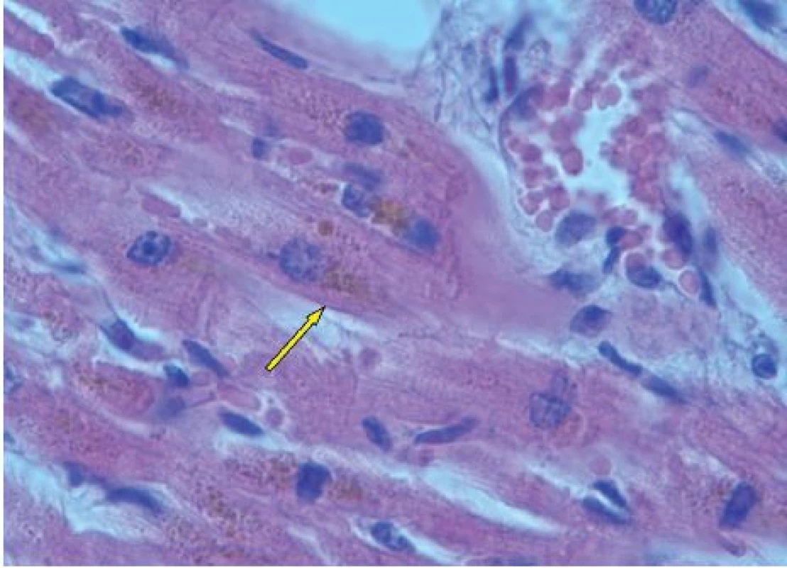 Depozita hemosiderinu v buňkách srdečního svalu, hematoxylin-eosin