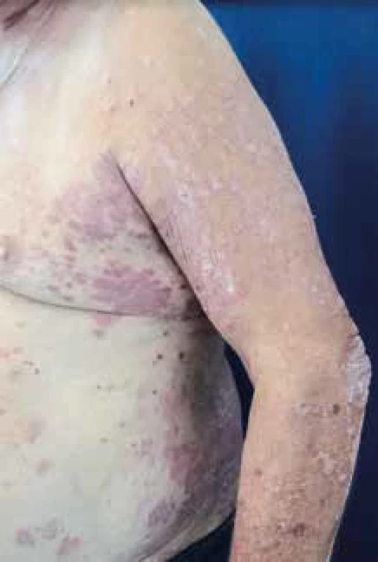 Muž, 65 let, psoriasis vulgaris – před zahájením konvenční terapie. [Foto: archiv autorky]