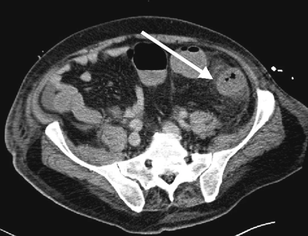 CT scan břicha, patrno prosáknutí tkání v okolí tračníku
Fig. 3. CT scan of the abdomen, infiltration of the colon-surrounding tissues is detectable
