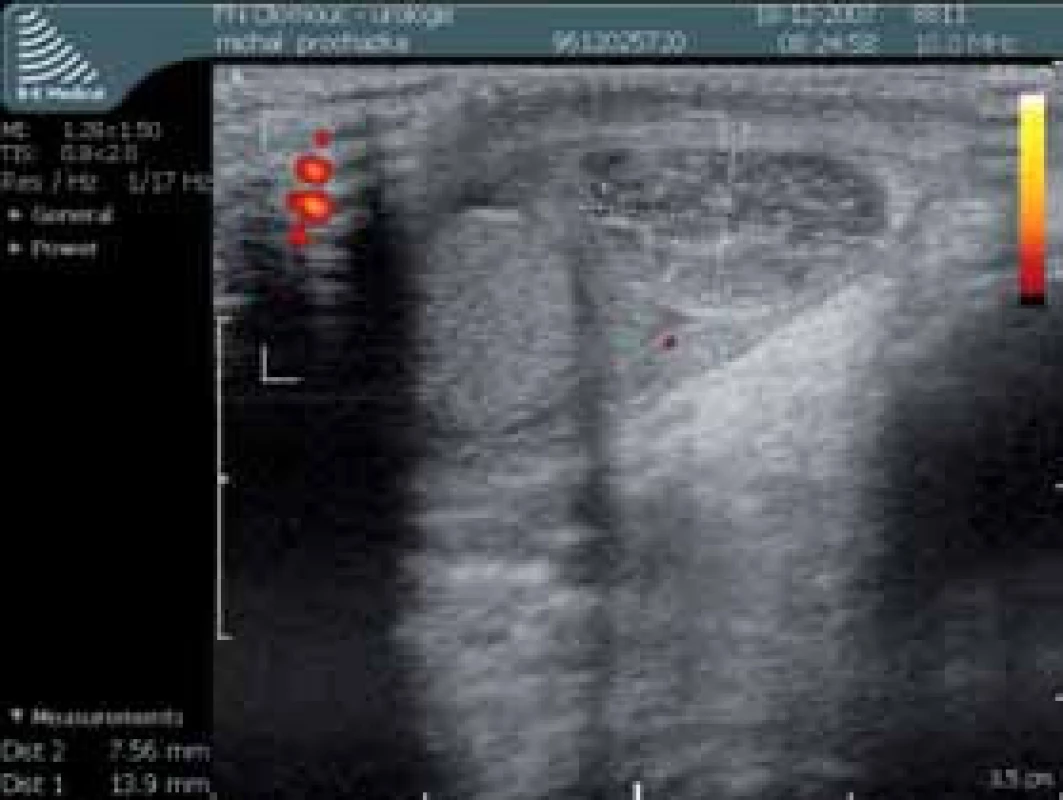 Stejný sonografický nález v zobrazení power doppler
Fig. 2. The same sonographic finding in power doppler imaging